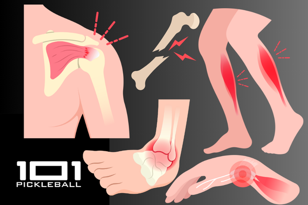 Common Injuries in Pickleball